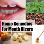 home-remedies-for-mouth-ulcers