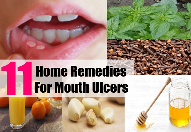 Natural Home Remedies For Mouth Ulcers