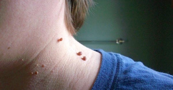 How to Remove Skin Tags with One Simple and Natural Ingredient