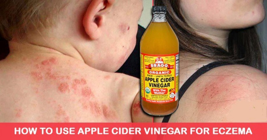 How To Use Apple Cider Vinegar To Treat Eczema